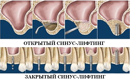 фото открытый и закрытый синус-лифтинг