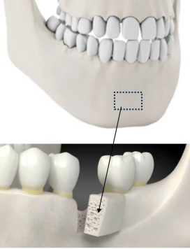 подсадка костного блока при имплантации
