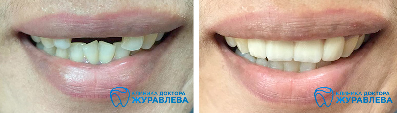 Дистализация 7-го зуба или как подвинуть зуб, чтобы получить место для имплантата?