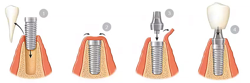 имплантация зубов, этап установки импланта