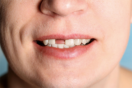 показания к имплантации зубов