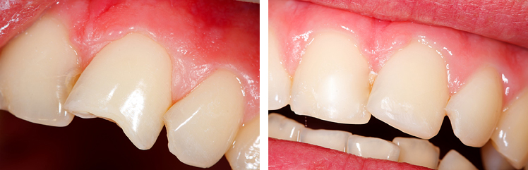 реставрация зубов в стоматологии фото до и после